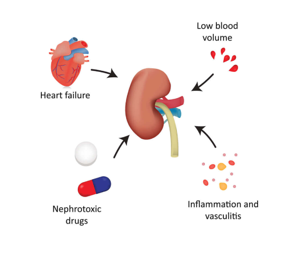 AKI Treatment by Kidney Specialist in Nagpur