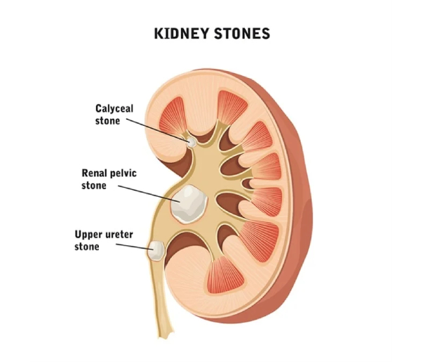 Kidney Stone Counseling in Nagpur